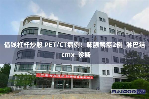 借钱杠杆炒股 PET/CT病例：肺腺鳞癌2例_淋巴结_cmx_诊断